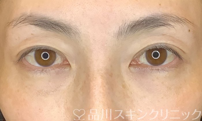 症例NO.70374のBEFORE写真