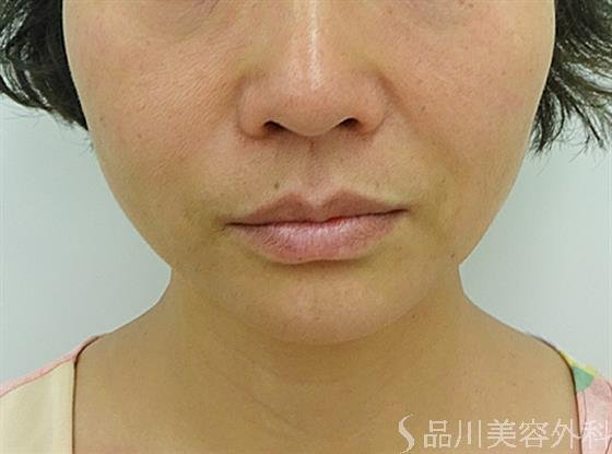 症例NO.44613のAFTER写真