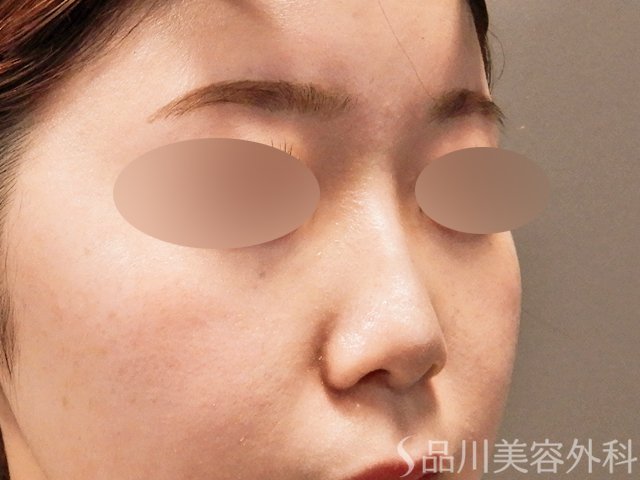 症例NO.69518のAFTER写真