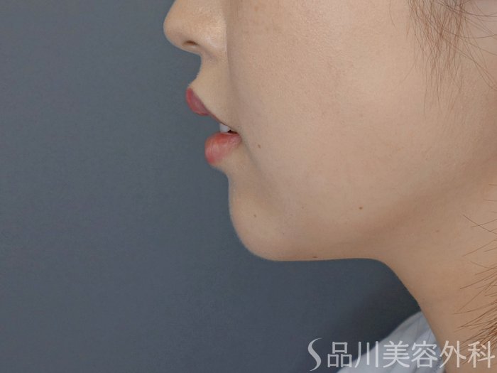 症例NO.71056のBEFORE写真