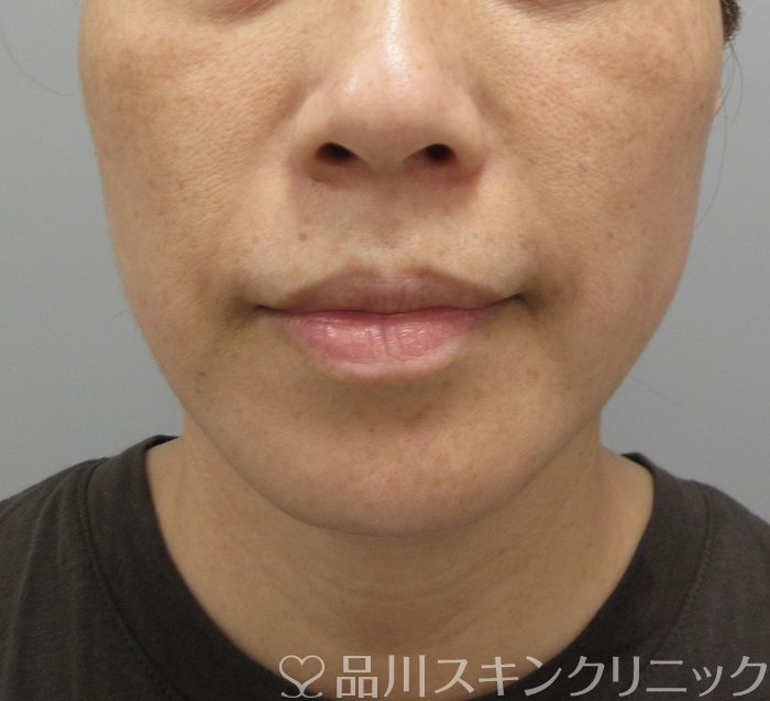 症例NO.71729のBEFORE写真