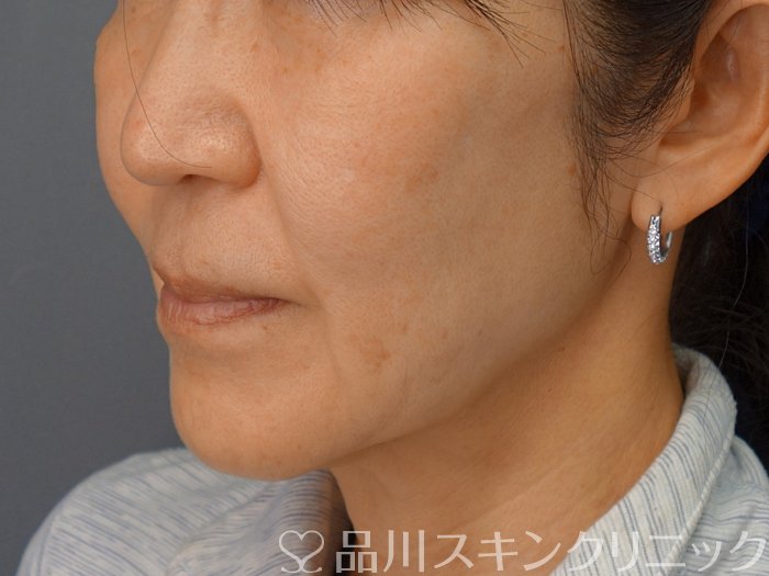 症例NO.74314のBEFORE写真
