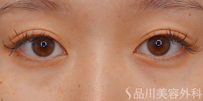症例NO.64659のBEFORE写真