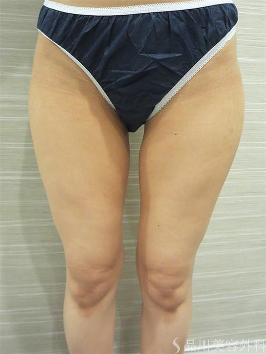 症例NO.22633のBEFORE写真