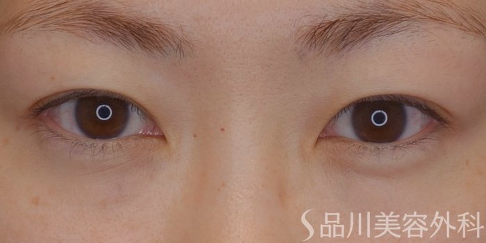 症例NO.74020のBEFORE写真