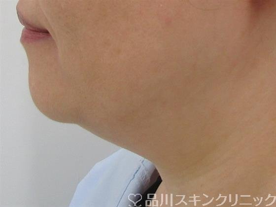 症例NO.42236のBEFORE写真