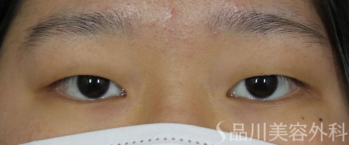 症例NO.71892のBEFORE写真