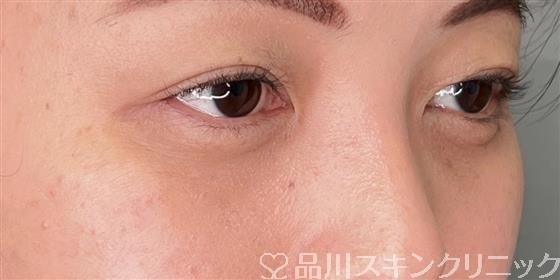 症例NO.56494のAFTER写真