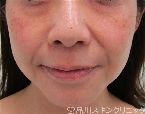 症例NO.34889のBEFORE写真