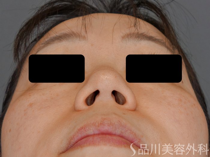 症例NO.74343のBEFORE写真