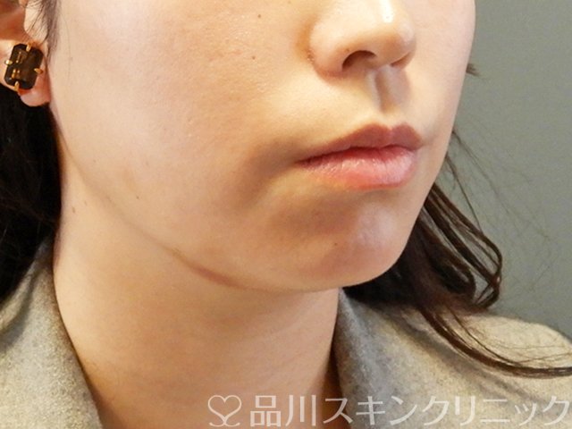 症例NO.63593のBEFORE写真