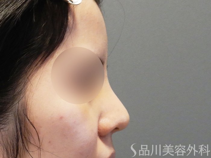 症例NO.71066のAFTER写真