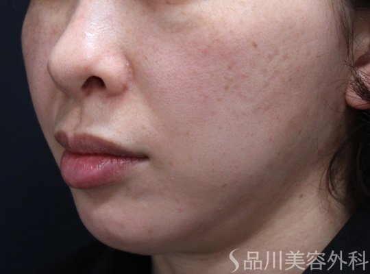 症例NO.64974のBEFORE写真