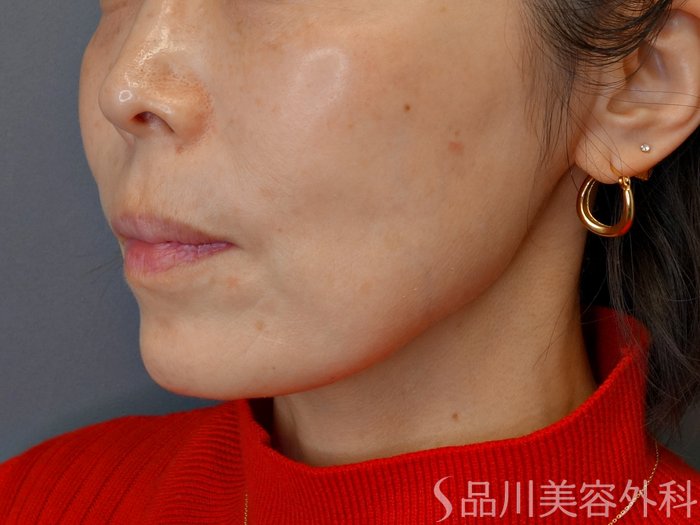 症例NO.73062のBEFORE写真