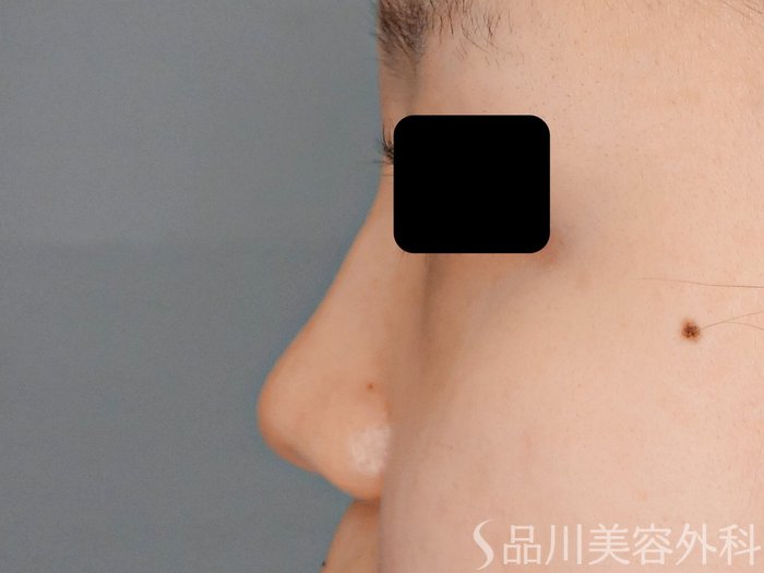 症例NO.70911のBEFORE写真