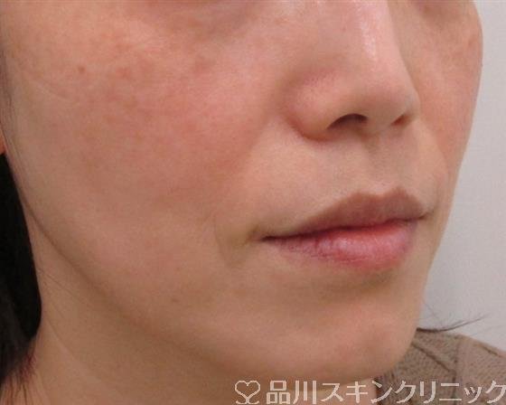 症例NO.41445のBEFORE写真