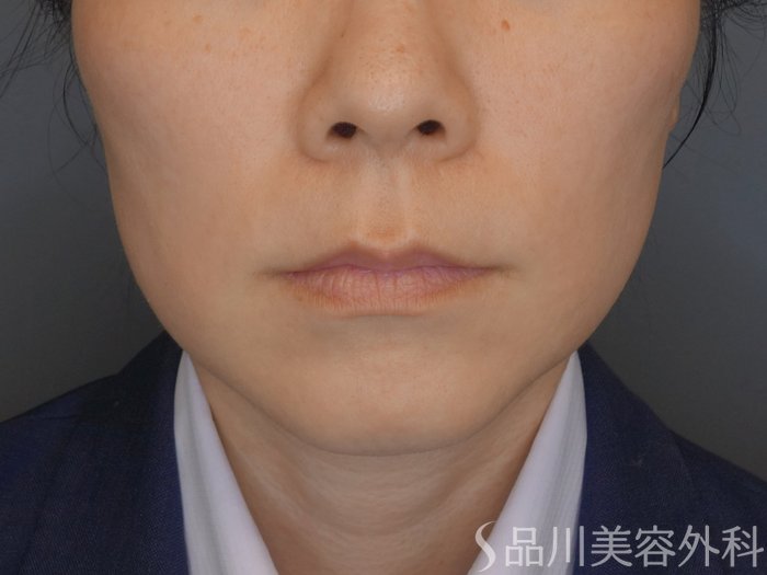 症例NO.70349のBEFORE写真