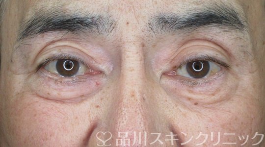 症例NO.70411のBEFORE写真