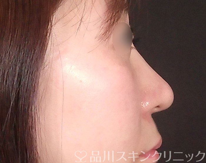 症例NO.69219のAFTER写真