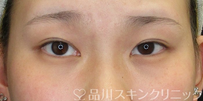 症例NO.73459のBEFORE写真