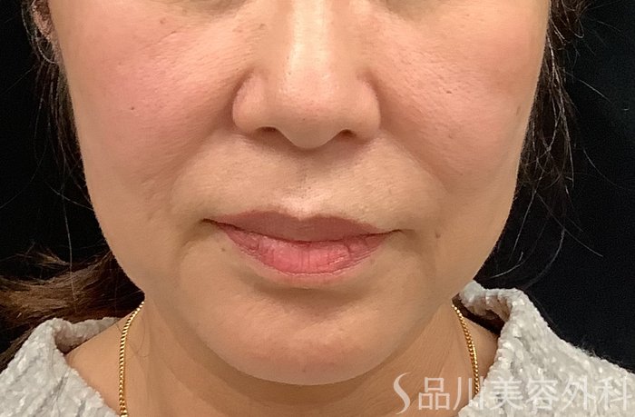 症例NO.67964のBEFORE写真