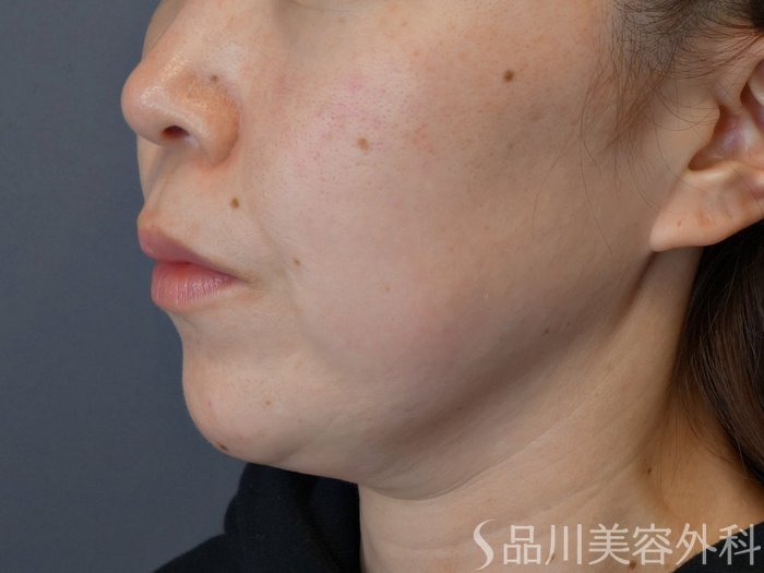 症例NO.73456のBEFORE写真