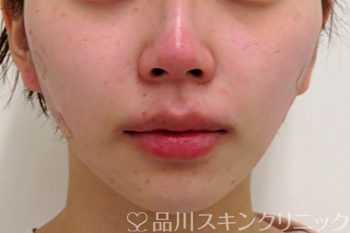 症例NO.74085のAFTER写真