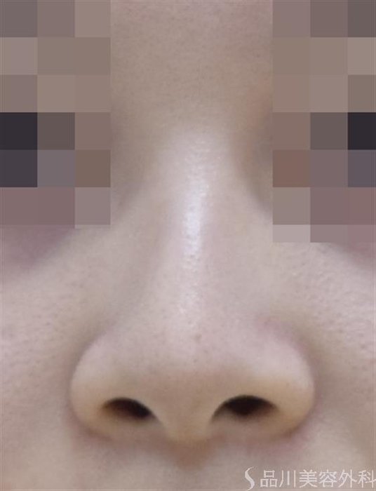 症例NO.47697のBEFORE写真