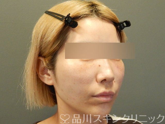 症例NO.65754のAFTER写真