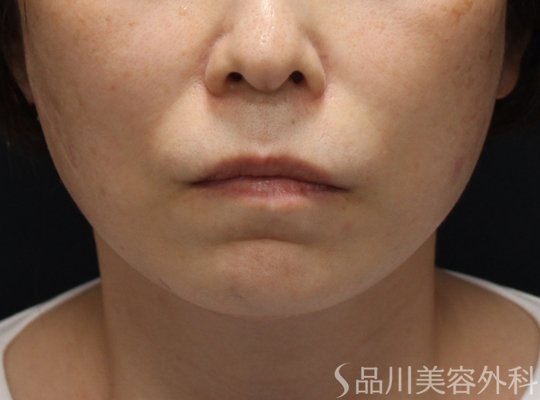 症例NO.74731のAFTER写真