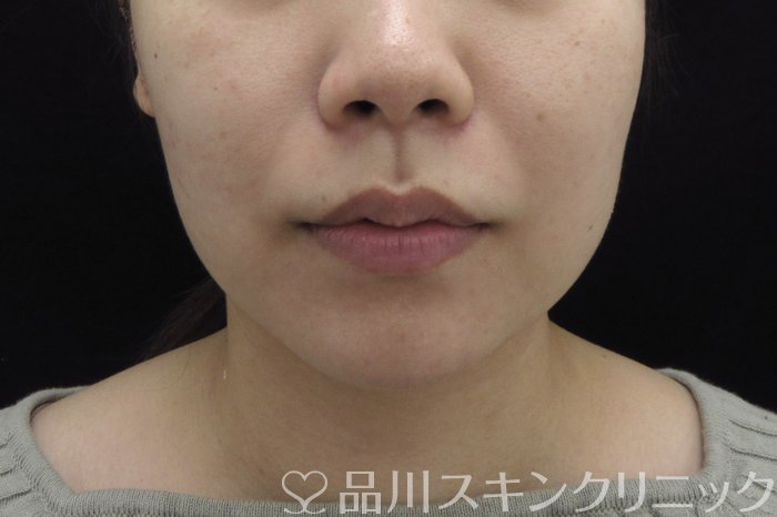 症例NO.74569のBEFORE写真