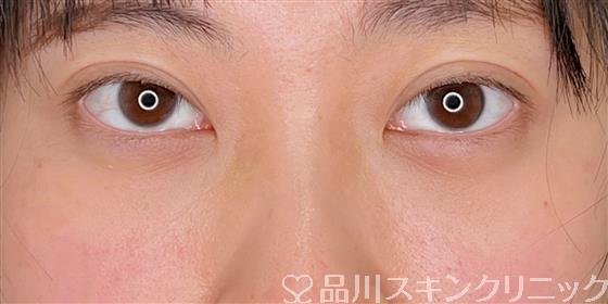症例NO.56432のAFTER写真