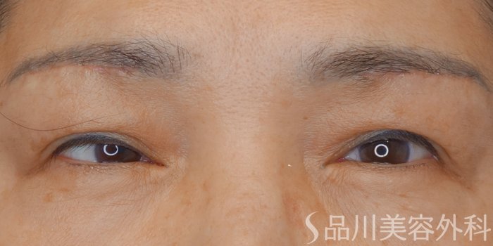 症例NO.72861のAFTER写真