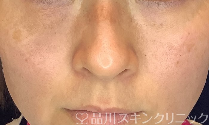症例NO.69498のAFTER写真