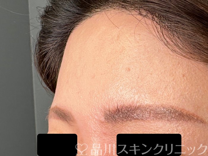 症例NO.62483のBEFORE写真