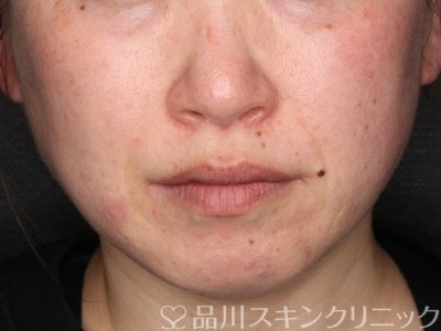 症例NO.75340のBEFORE写真