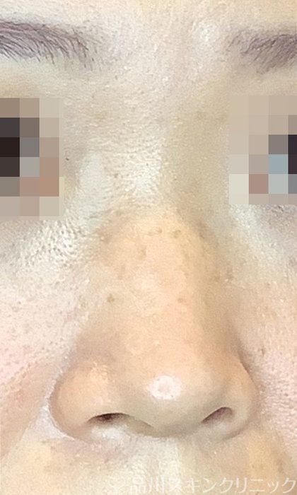 症例NO.74607のBEFORE写真