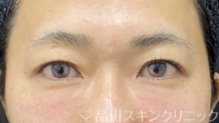 症例NO.73582のAFTER写真