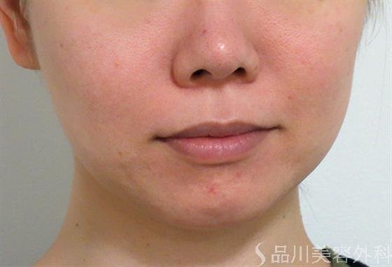 症例NO.36422のBEFORE写真
