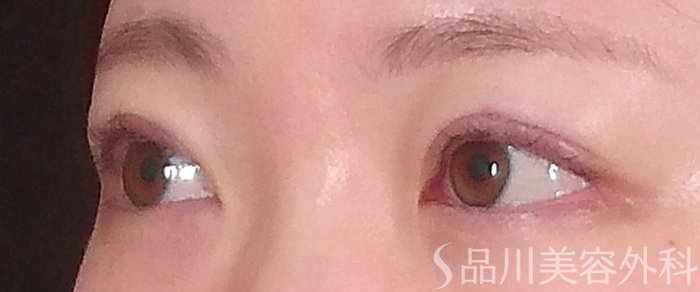 症例NO.70990のAFTER写真