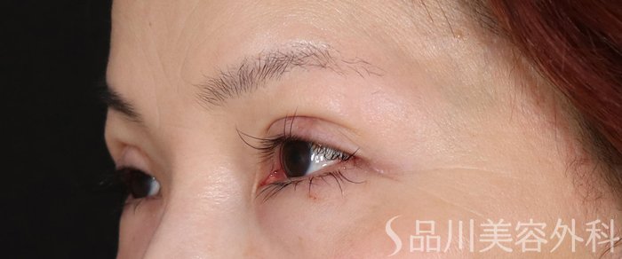 症例NO.73129のAFTER写真