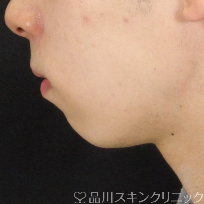 症例NO.70546のBEFORE写真
