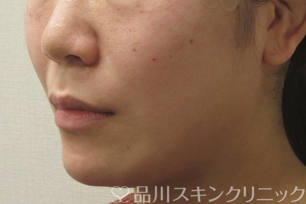 症例NO.74445のAFTER写真
