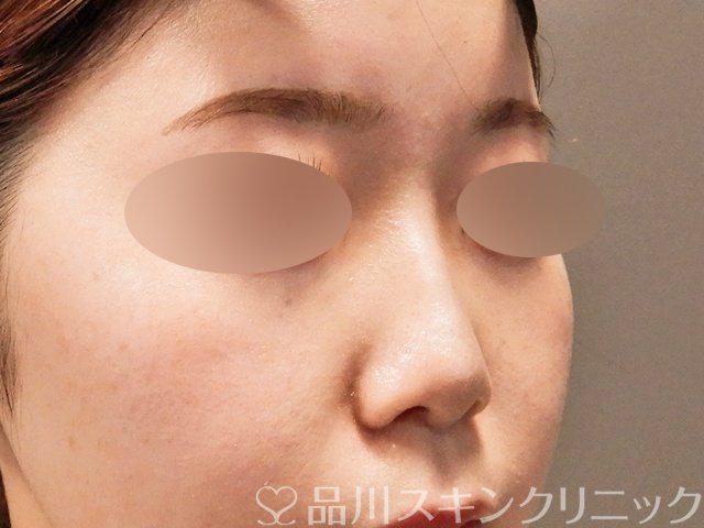 症例NO.69518のAFTER写真