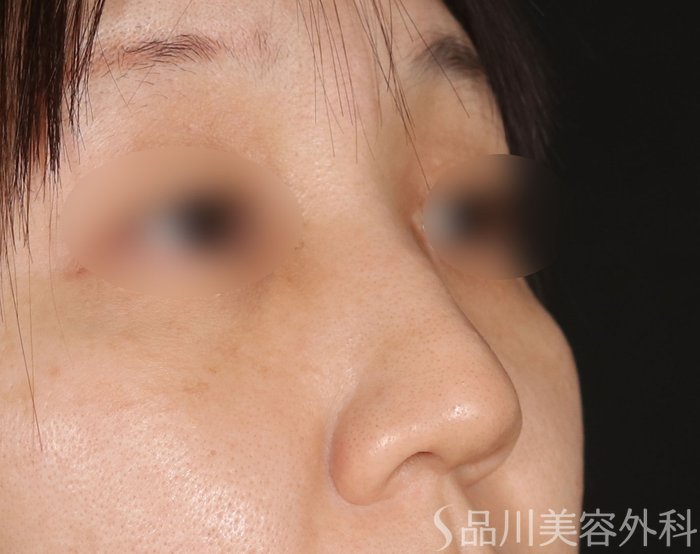 症例NO.72589のBEFORE写真