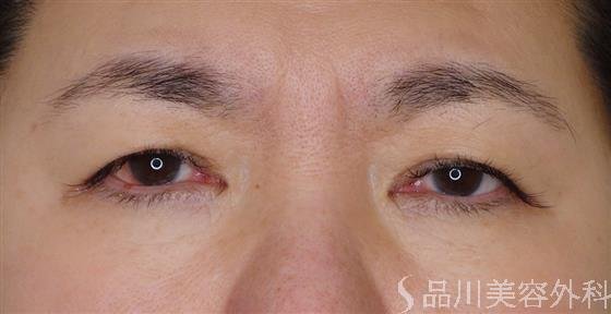 症例NO.51173のBEFORE写真