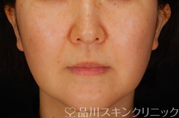 症例NO.65318のBEFORE写真
