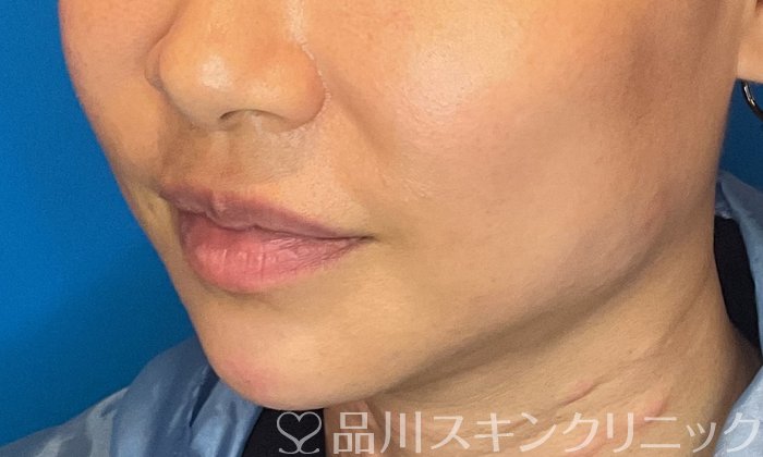 症例NO.74486のAFTER写真