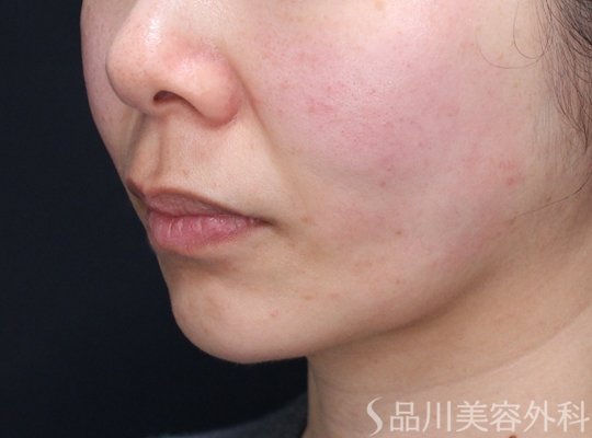 症例NO.73035のAFTER写真