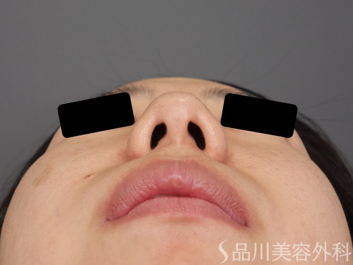 症例NO.74328のBEFORE写真